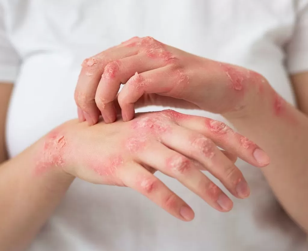 Bacterial skin infection treatment consultation at Signature Skin Jaipur