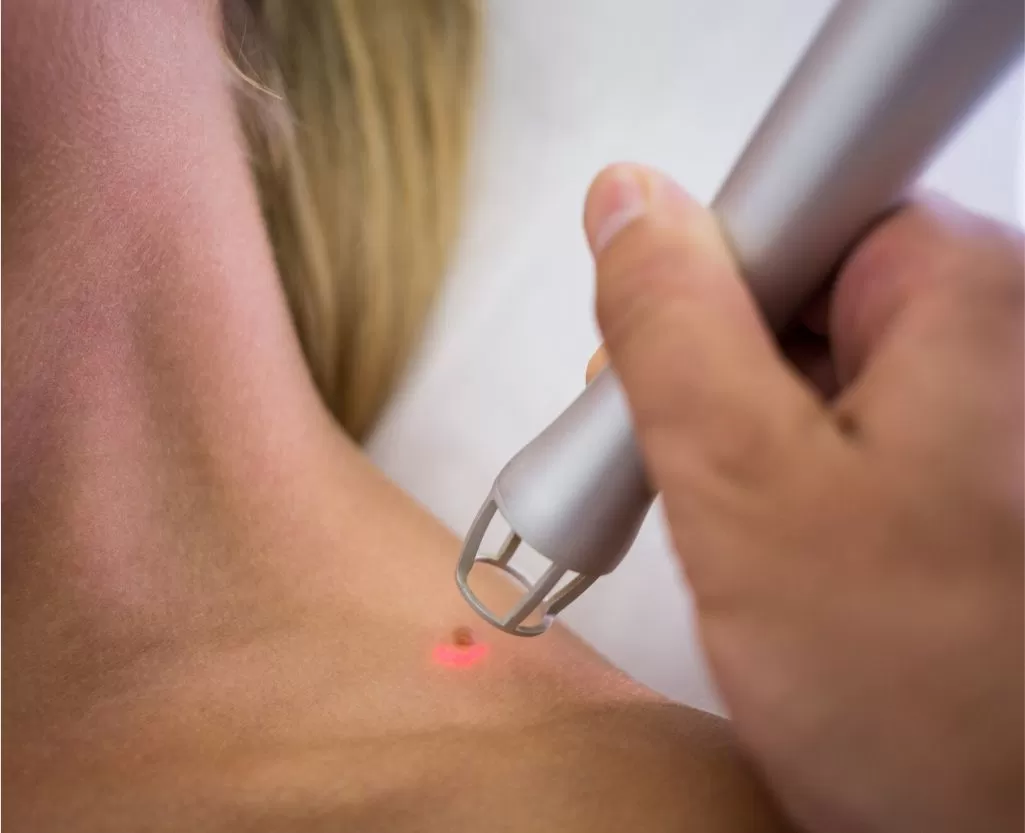 Birthmark evaluation and treatment consultation at Signature Skin Jaipur
