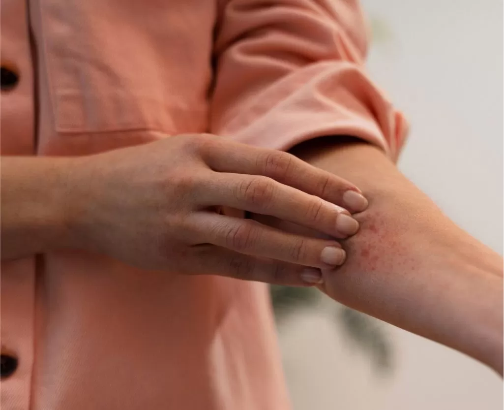 Cellulitis treatment consultation at Signature Skin Jaipur