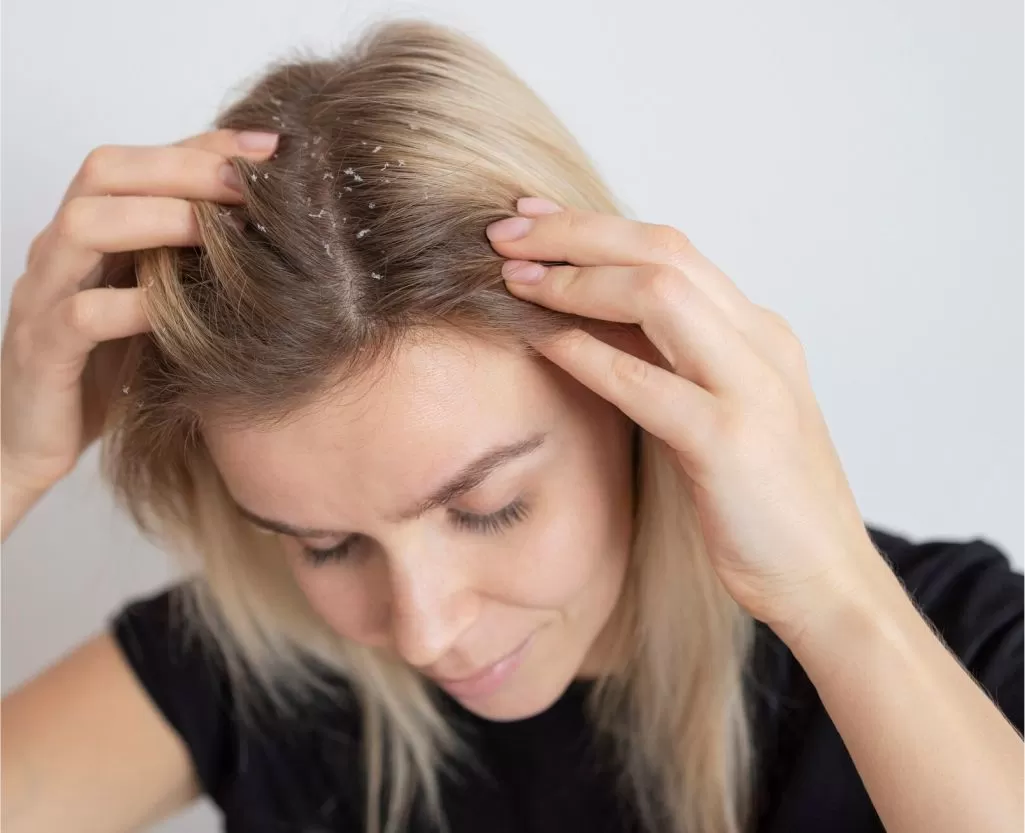 Dandruff treatment consultation at Signature Skin Jaipur