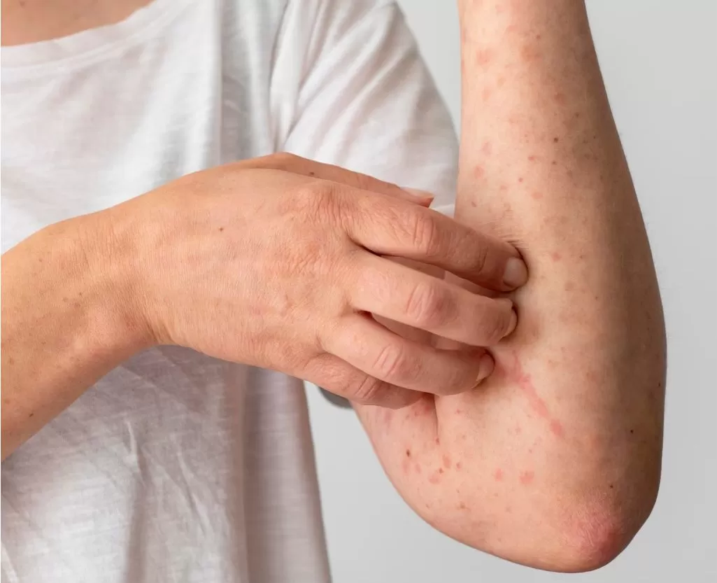 Dermatitis and eczema treatment consultation at Signature Skin Jaipur
