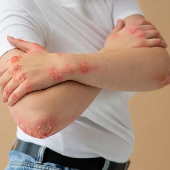 Drug Rash Treatment at Signature Skin Jaipur