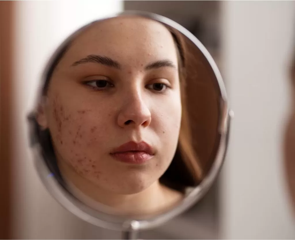 Acne scarring treatment consultation at Signature Skin Jaipur