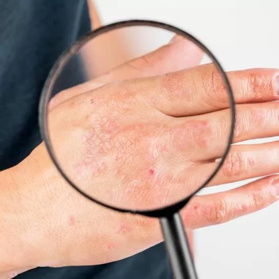 Hidradenitis Suppurativa Treatment at Signature Skin Jaipur