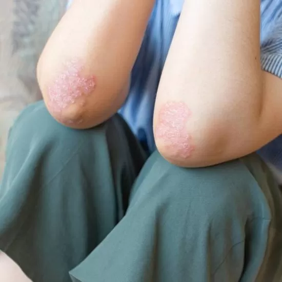 Ichthyosis vulgaris treatment consultation at Signature Skin Jaipur