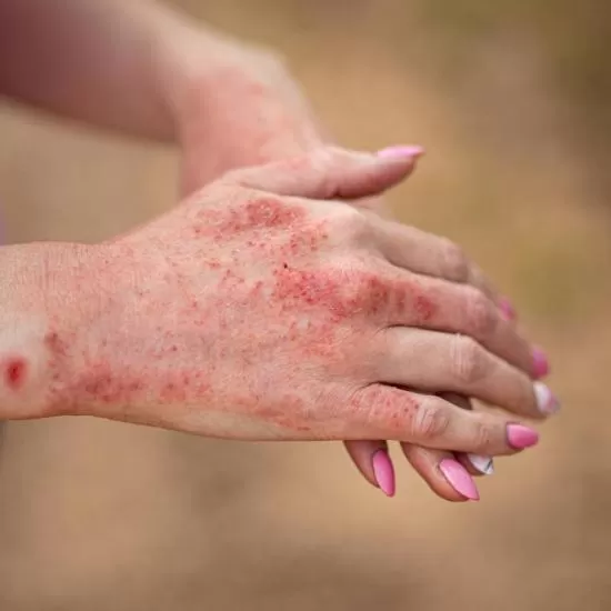 Insect bite reaction treatment consultation at Signature Skin Jaipur