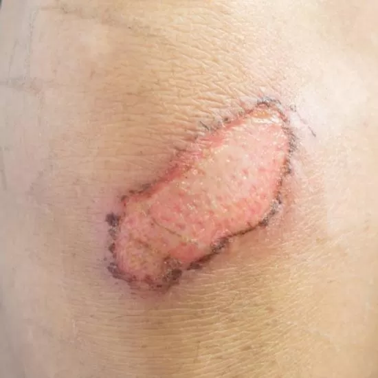Keloid and hypertrophic scar treatment consultation at Signature Skin Jaipur