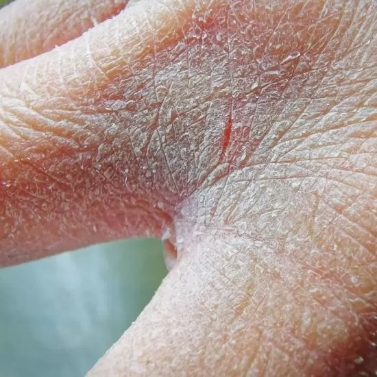 Lichen Planus Treatment at Signature Skin Jaipur