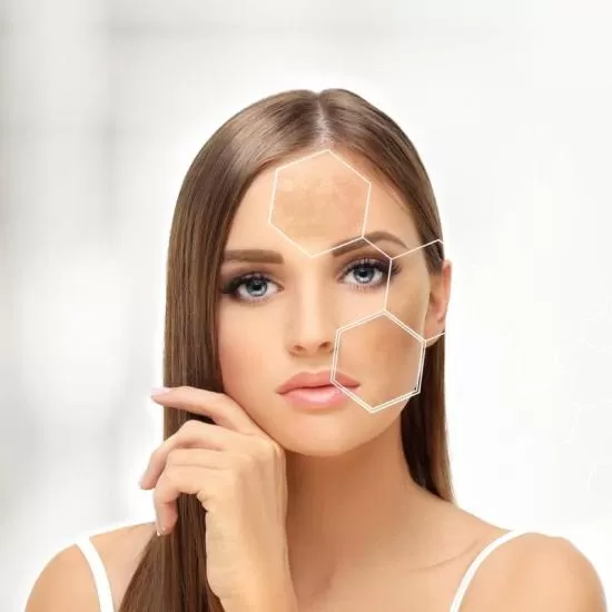 Melasma Treatment at Signature Skin Jaipur