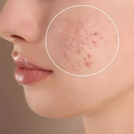 Milia and Skin Cysts Treatment at Signature Skin Jaipur