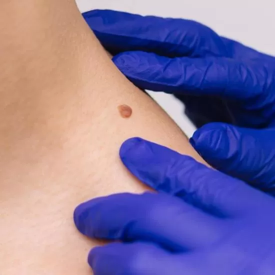Moles (Nevi) Evaluation at Signature Skin Jaipur