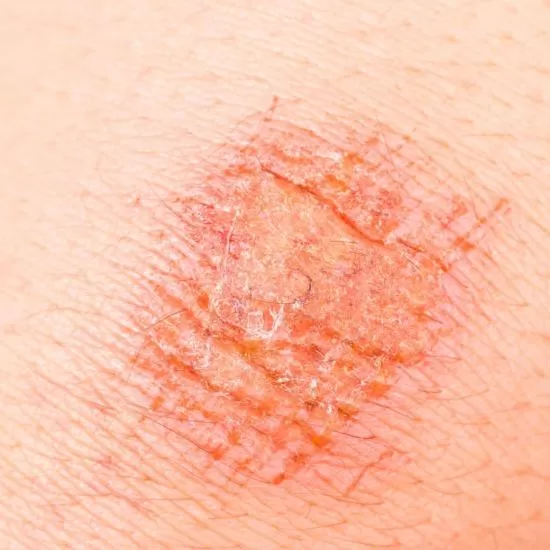 Tzanck smear test at Signature Skin Jaipur