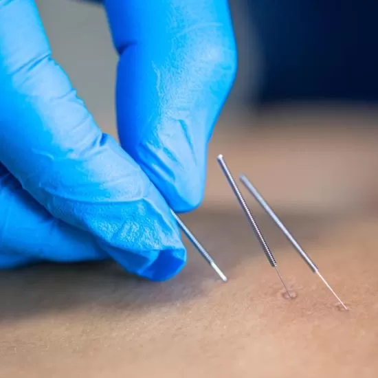 Needle Extirpation at Signature Skin Jaipur