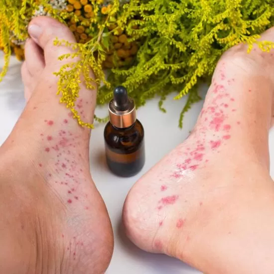 Biological Therapy for Psoriasis at Signature Skin Jaipur