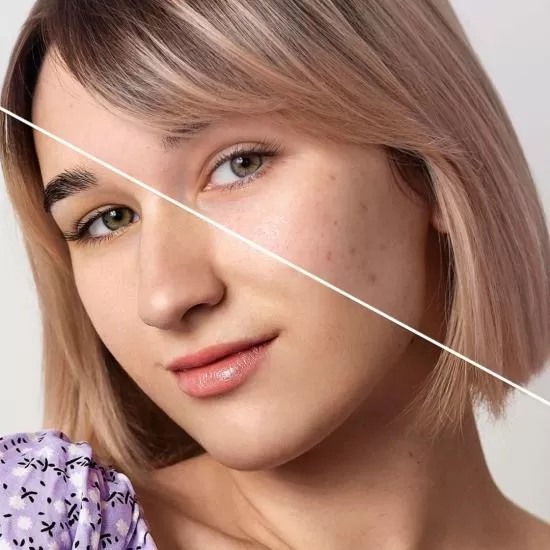 Laser treatments at Signature Skin Jaipur