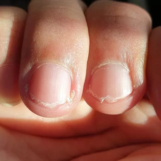 Nail Disease Treatment at Signature Skin Jaipur