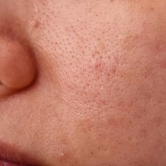 Open Pores Treatment at Signature Skin Jaipur