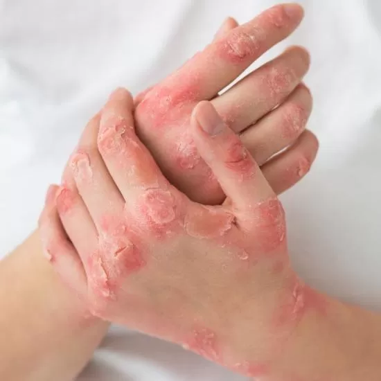 Psoriasis Treatment at Signature Skin Jaipur
