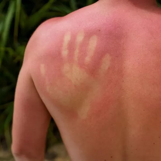 Pityriasis Versicolor Treatment at Signature Skin Jaipur