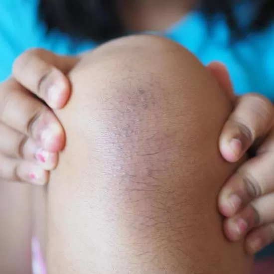 Scabies Treatment at Signature Skin Jaipur