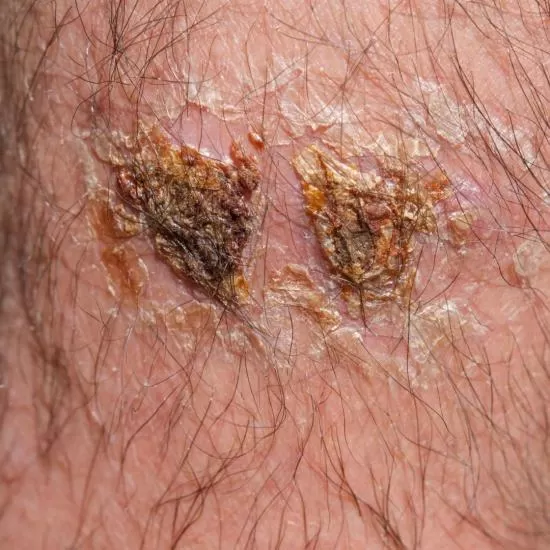 Seborrheic Keratosis Removal at Signature Skin Jaipur
