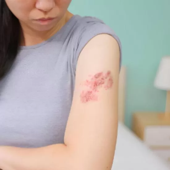 Vasculitis Treatment at Signature Skin Jaipur