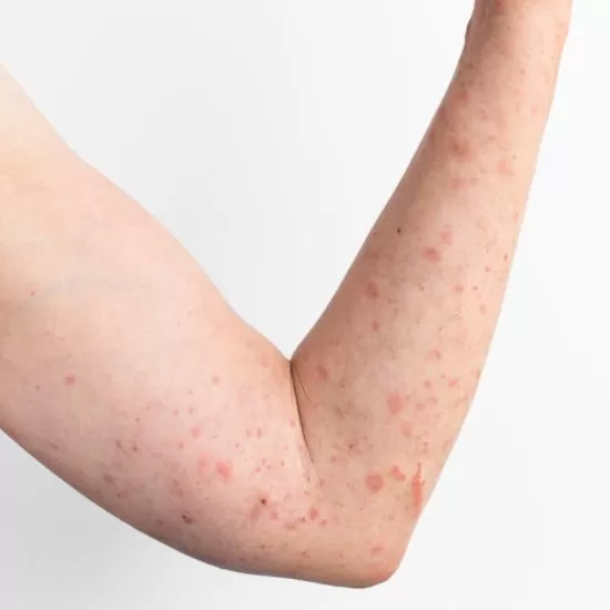 Varicose Eczema Treatment at Signature Skin Jaipur