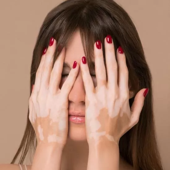 Vitiligo Treatment at Signature Skin Jaipur